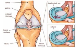 כל מה שאתם צריכים לדעת על החלפת ברך החלפת ברך